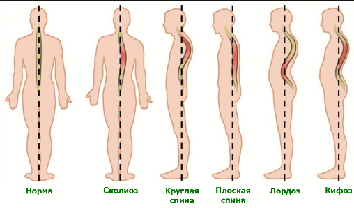 Искривления позвоночника.